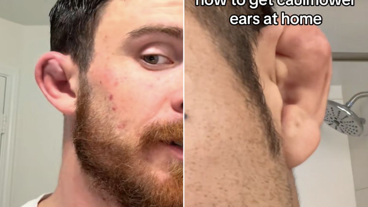 Une mode inquiétante sur TikTok : se créer des oreilles en chou-fleur